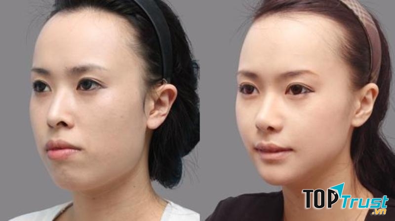 Kết quả trước và sau phẩu thuật hàm hô tại TMV Á Âu
