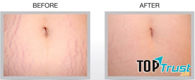 Hiệu quả rõ nét sau điều trị tại bệnh viện thẩm mỹ Á Âu