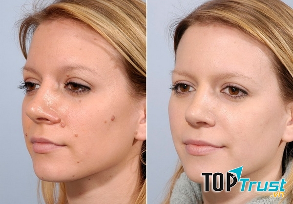 Nốt ruồi hoàn toàn biến mất sau quy trình điều trị tại TMV Hiệp Lợi