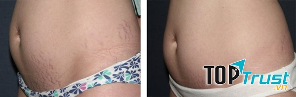 Tình trạng rạn da hạn chế rõ rệt sau quy trình điều trị tại Hiệp Lợi