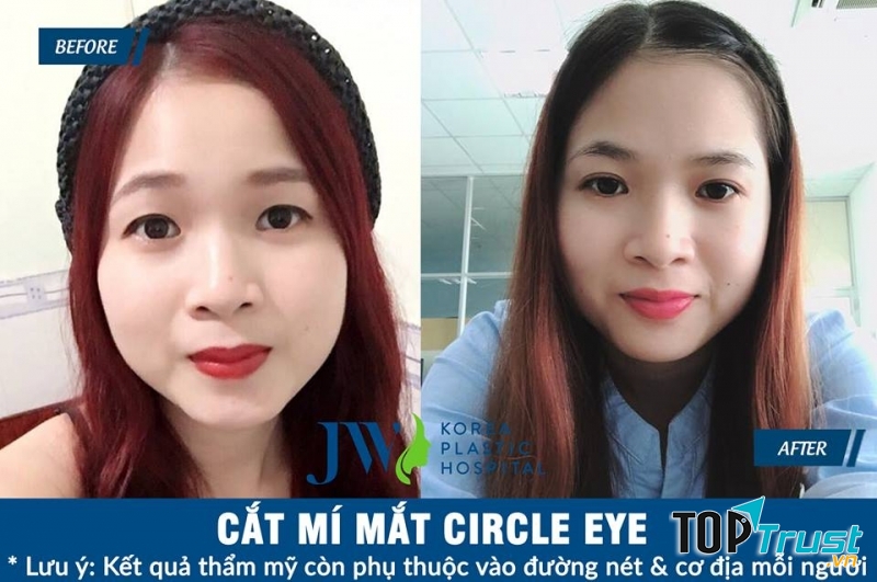 Bệnh Viện Thẩm Mỹ JW Hàn Quốc - địa chỉ nhấn mí mắt đẹp và an toàn nhất ở TP. HCM