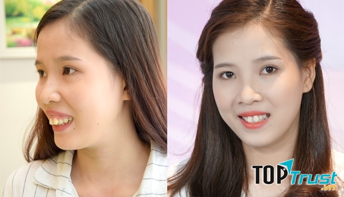 Khách hàng sau phẩu thuật có vẻ đẹp vượt trội