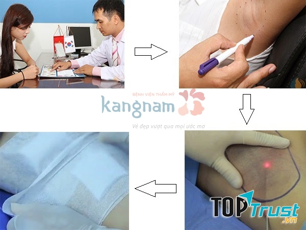 Qui trình 4 bước điều trị hôi nách tại TMV Kangnam