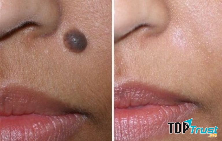 Hình ảnh thực tế sau điều trị