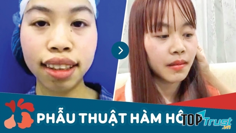 Cận cảnh kết quả phẩu thuật chỉnh hàm tại Kangnam