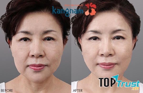 Bệnh viện thẩm mỹ Kangnam