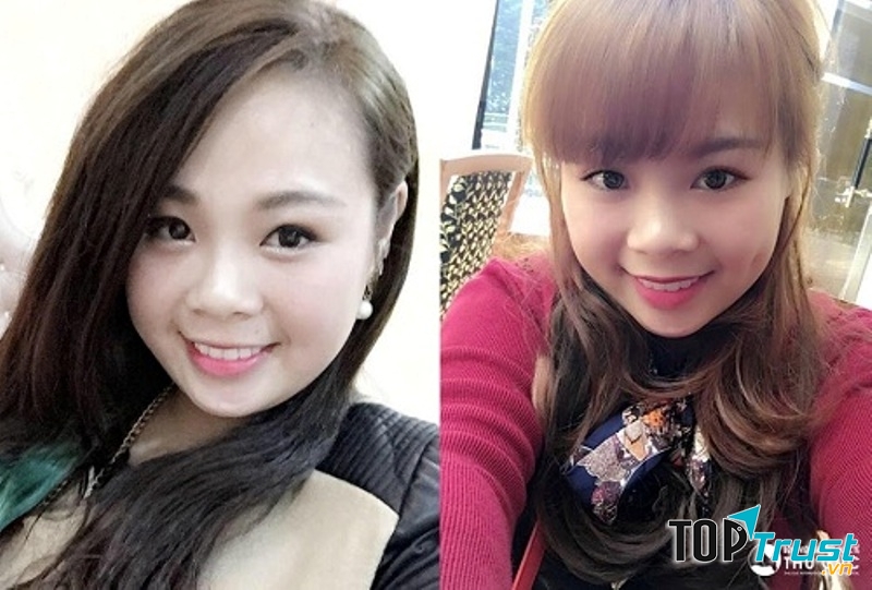 Cắt má lúm tại Thu Cúc thực hiện theo công nghệ chuẩn Hàn