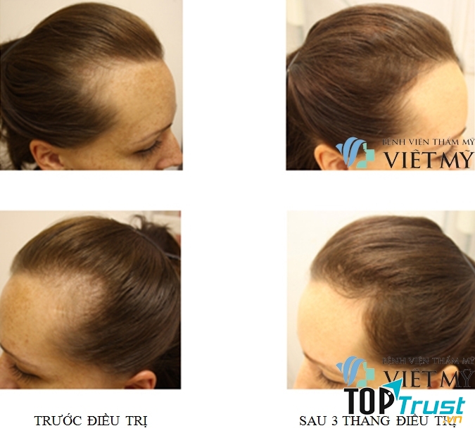 Đến TMV Việt Mỹ - rụng tóc không còn là nỗi lo