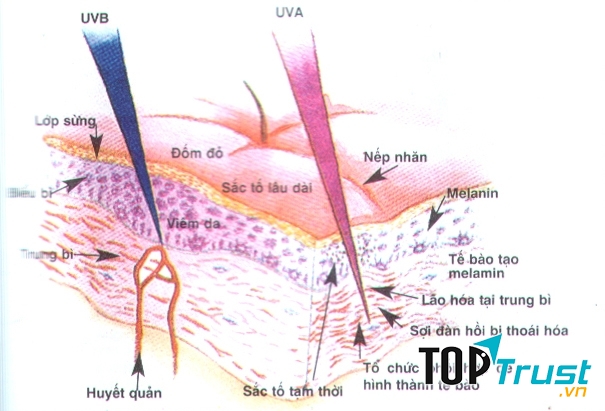 Tia UVA, UVB trong ánh nắng mặt trời gây nám da