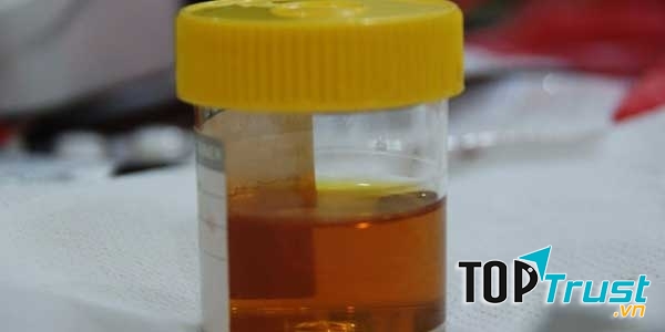 Nước tiểu sẫm màu là triệu chứng của ung thư gan