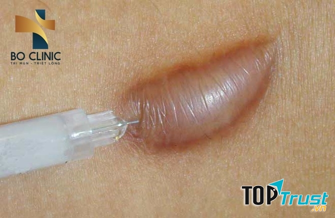 Công nghệ đặc trị sẹo bằng thuốc K-CORT