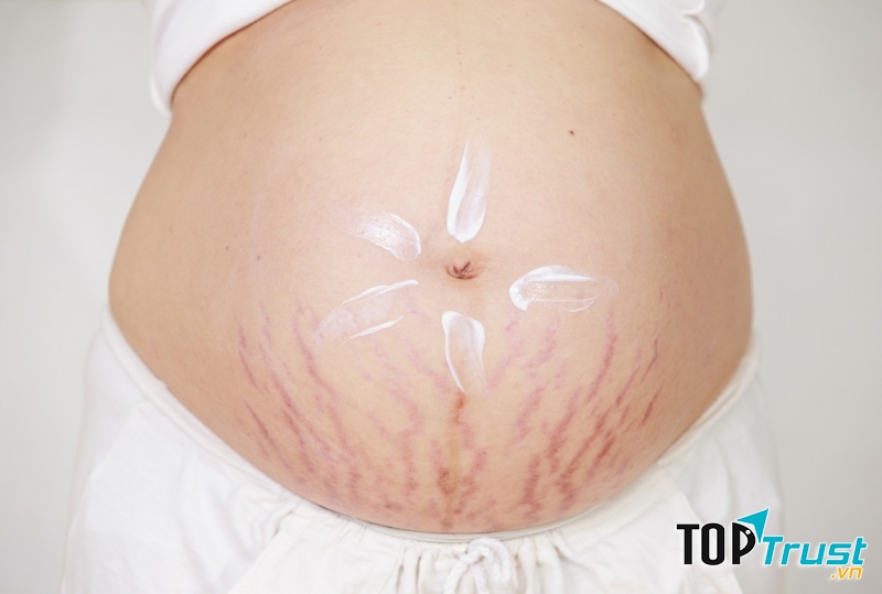 Có thể dùng các loại kem làm ẩm da và mềm da toàn thân hay tại chỗ để làm mềm, dịu đi làn da