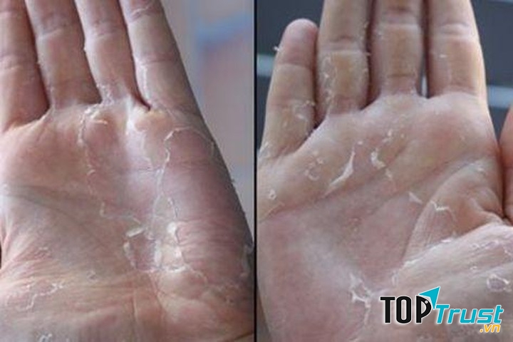 Khi cơ thể bị thiếu hụt vitamin và các khoáng chất, dấu hiệu cho thấy điều đó là làn da bạn sẽ bị bong tróc.