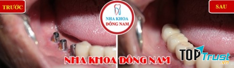 Trồng ba răng Implant hàm dưới
