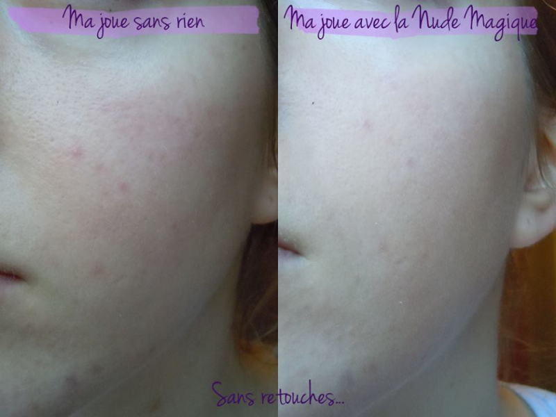 sản phẩm có tác dụng làm cho khô đầu mụn, các đốm mụn sưng mụn đỏ sẽ xẹp hẳn, nhân mụn cũng sẽ dễ dàng lấy đi mà không để lại sẹo thâm.