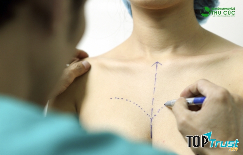 Ca phẫu thuật nâng ngực đầu tiên diễn ra vào năm 1962