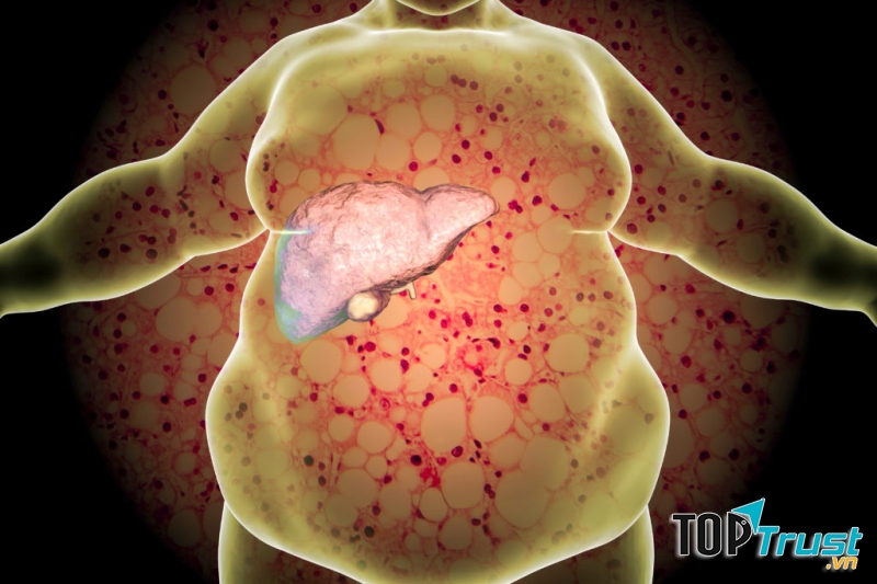 Uống nhiều rượu vào dịp Tết sẽ có nguy cơ bị viêm gan, gan nhiễm mỡ...