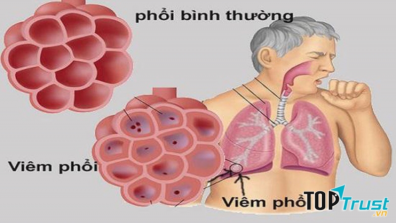 Các bệnh về phổi có thể gây nguy hiểm tới tính mạng con người