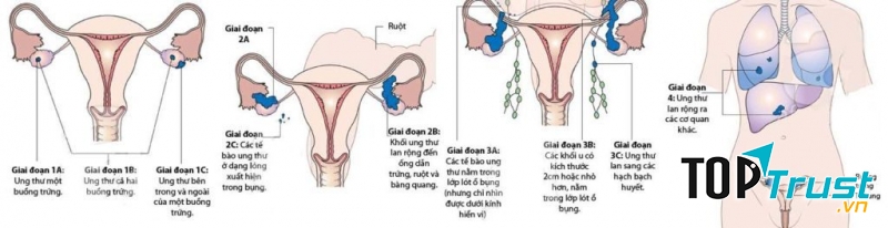 Các giai đoạn phát triển ung thư buồng trứng