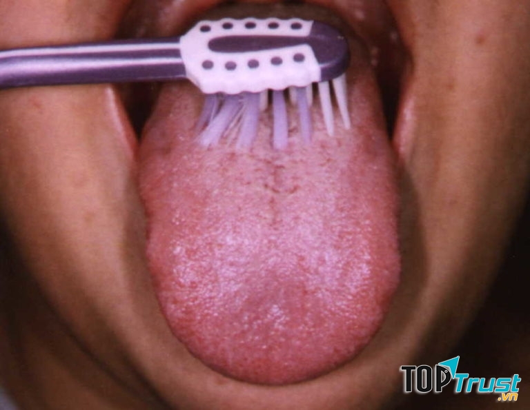 Việc vệ sinh răng miệng kém dẫn đến việc xuất hiện các mảng trắng, bựa trên lưỡi