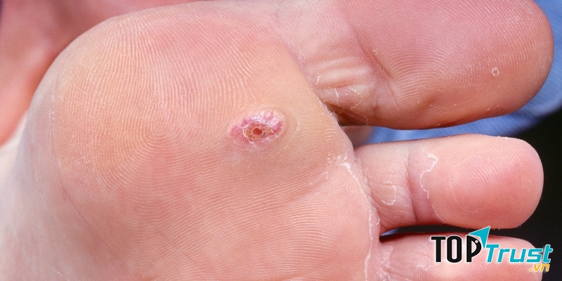 Các vết nứt không lành