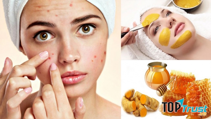 Cách trị mụn thâm bằng mật ong