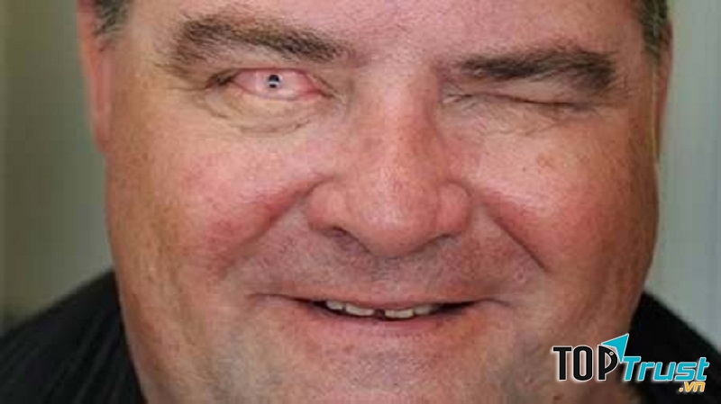 Cấy ghép răng vào mắt