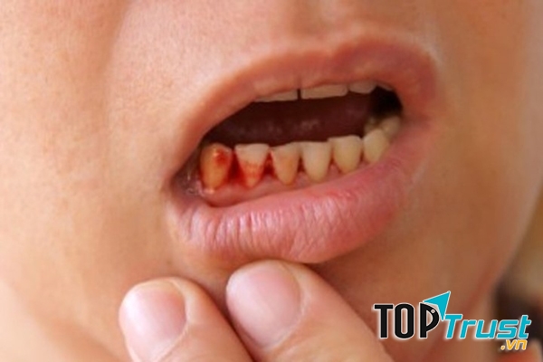 Chải răng quá mạnh làm tổn thương răng của bạn