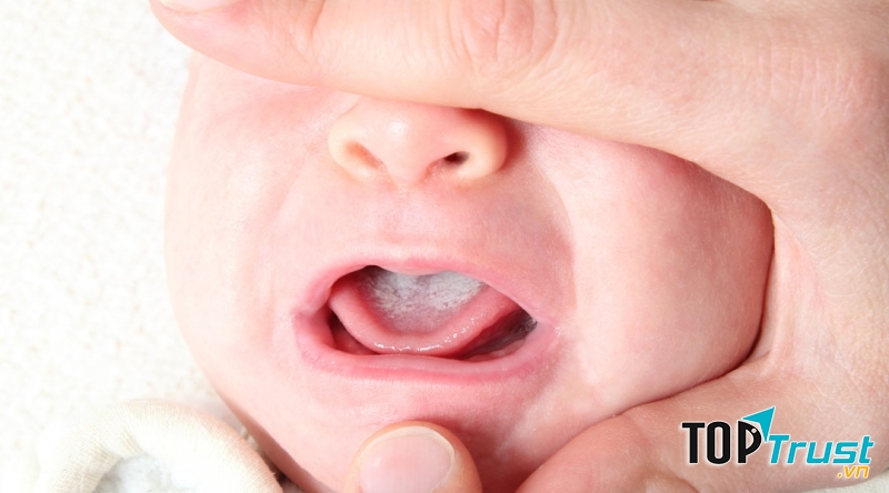 Trẻ dễ bị tưa lưỡi do ngậm vú trong lúc ngủ