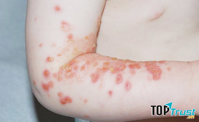 Biểu hiện rõ ràng nhất của bệnh là trên người trẻ sẽ xuất hiện những nốt mụn, gây đau và ngứa, sau đó vỡ ra, rỉ nước trong một vài ngày và đóng vảy