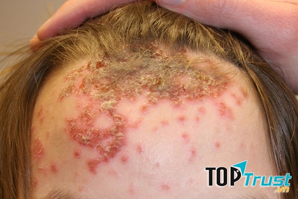 Bệnh chốc là căn bệnh thường gặp ở trẻ em từ 2 đến 6 tuổi, và hay gặp vào mùa hè