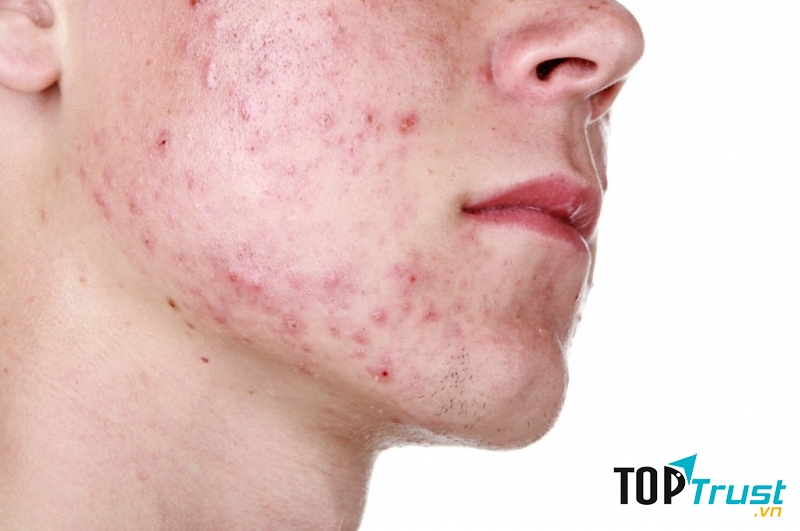 Chữa nhiệt lợi do nguyên nhân nóng trong