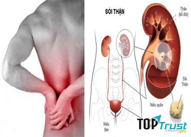 Rau diếp chữa bệnh sỏi thận