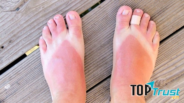 Son dưỡng làm dịu và mờ vết cháy nắng