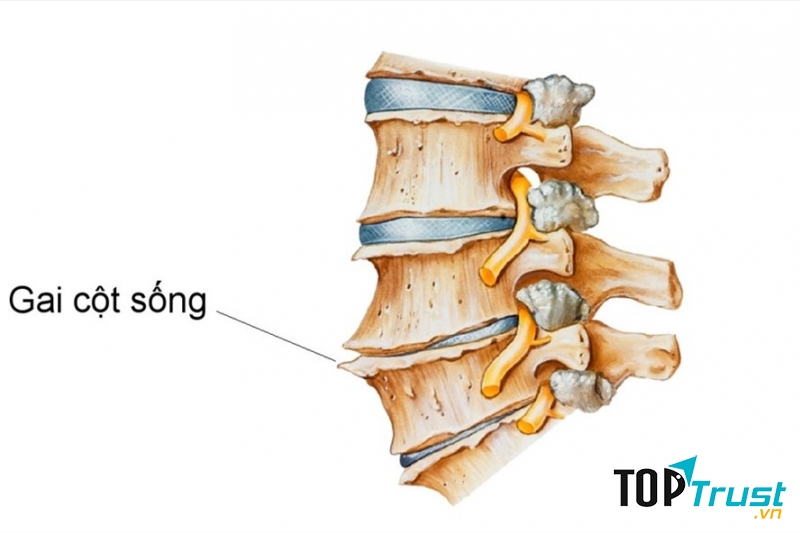 Chữa gai cột sống