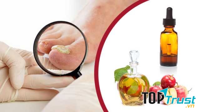 Các hoạt chất được cho là tạo độ pH cho giấm sẽ tiêu diệt nấm móng chân.