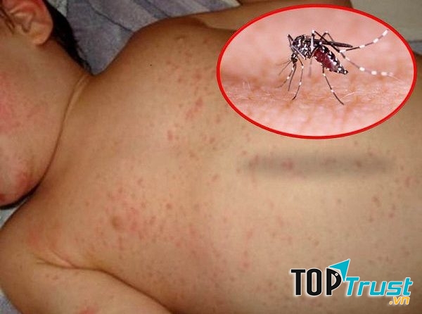 Rau diếp cá là vị thuốc thích hợp cho bệnh sốt xuất huyết.