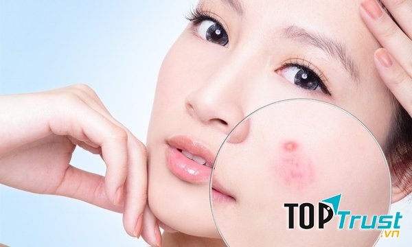 Chữa trị và nghe theo lời khuyên của bác sĩ da liễu