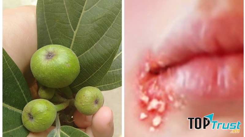 Lá sung có tính sát trùng, tiêu viêm tốt từ xa xưa đã được sử dụng trong các bài thuốc điều trị zona thần kinh, chống viêm nhiễm