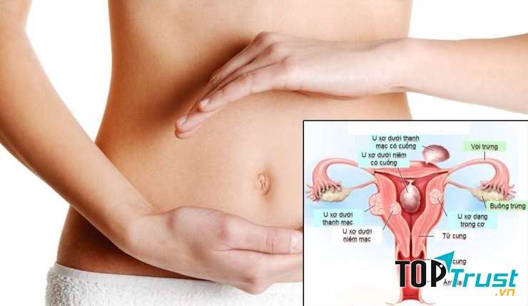 Chướng bụng - Dấu hiệu cảnh báo mắc u xơ tử cung