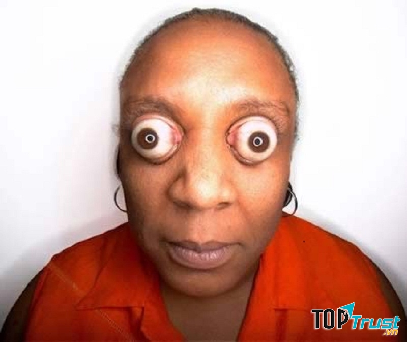 Con ngươi lồi ra khỏi hốc mắt