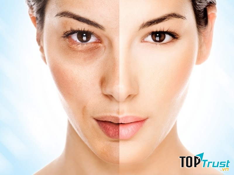 Công nghệ Spectra Laser tại Nhật Mỹ Spa