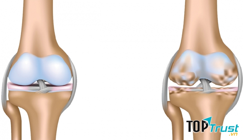 Xương bình thường và xương bị tổn thương