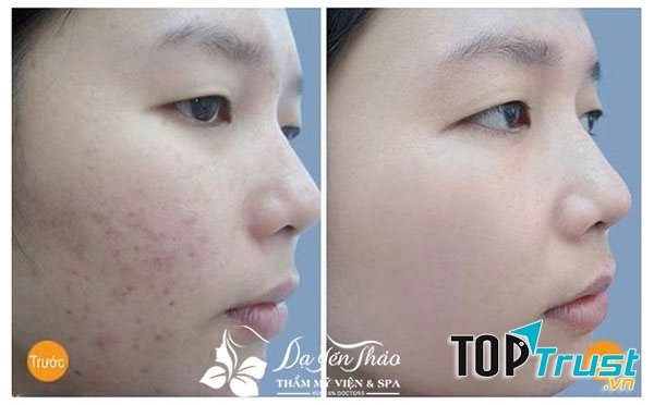 Dạ Yến Thảo Spa - Spa trị mụn tốt nhất tại Hà Nội