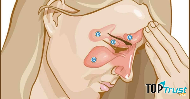 Đau đầu do xoang thường gặp ở những người bị xoang