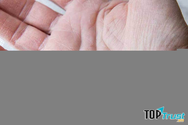 Dầu dừa điều trị vảy nến