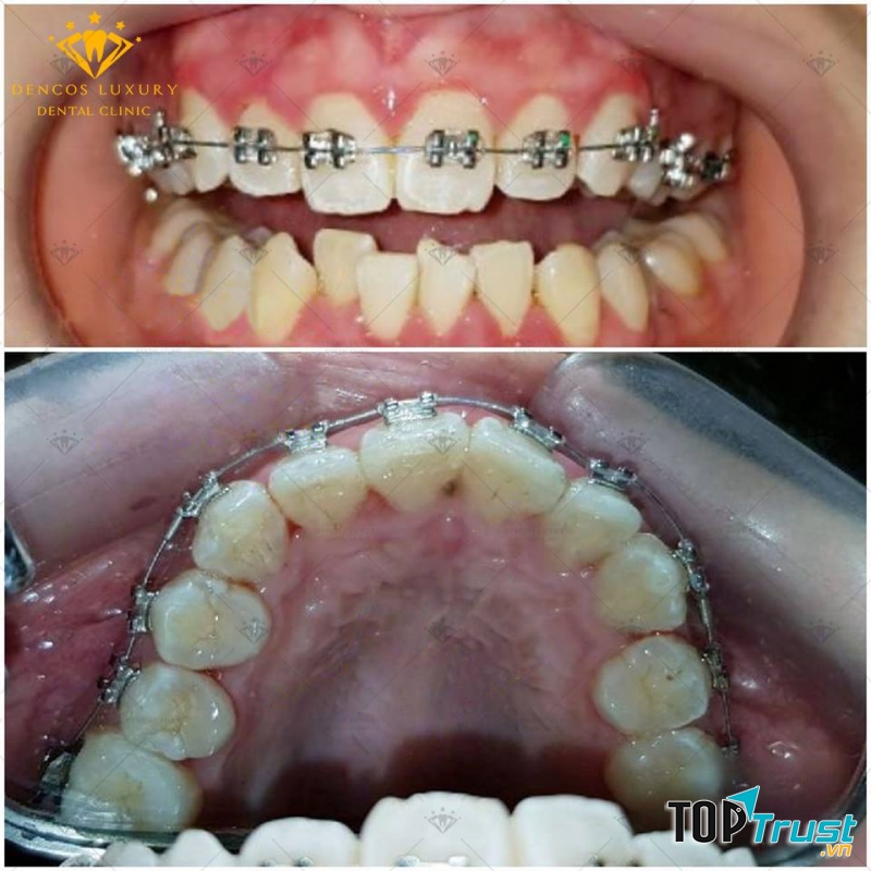 Hình ảnh niềng răng tại Dencos Luxury