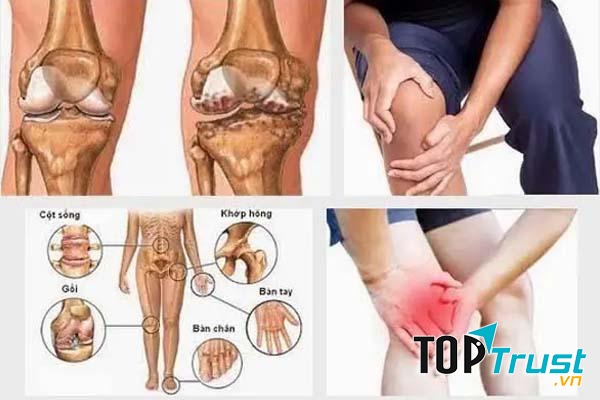 Nếu trong gia đình có người bị bệnh liên quan đến khớp thì khả năng đời sau sẽ mắc khớp tỉ lệ lên tới 90%.