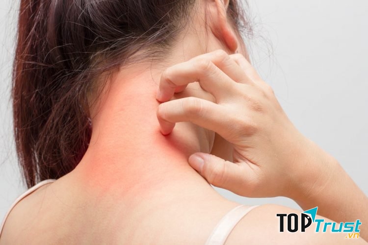 Dị ứng thức ăn là căn bệnh vô cùng phổ biến trong dịp Tết