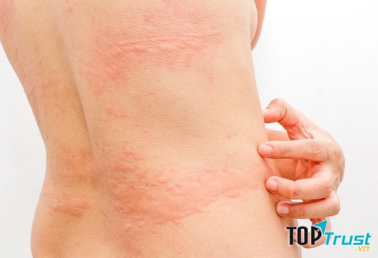 Dị ứng lạnh mày đay